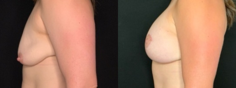 Patient #92468: Breast Augmentation Combine Image