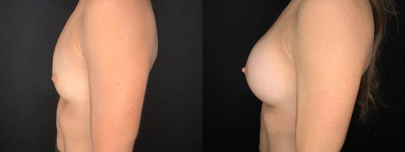 Patient #62458: Breast Augmentation Combine Image