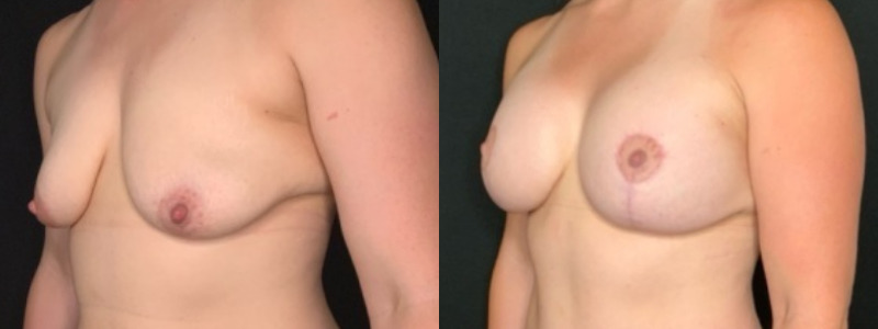 Patient #92468: Breast Augmentation Combine Image