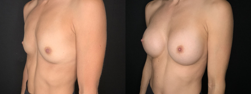 Patient #62458: Breast Augmentation Combine Image