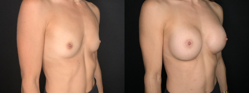 Patient #62458: Breast Augmentation Combine Image