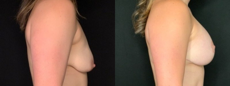 Patient #92468: Breast Augmentation Combine Image
