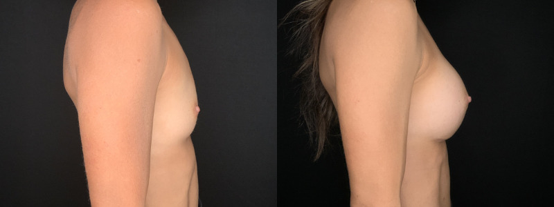 Patient #62458: Breast Augmentation Combine Image
