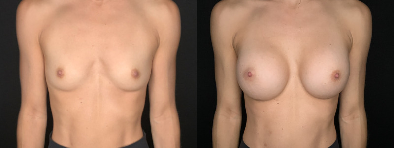 Patient #62458: Breast Augmentation Combine Image