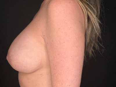 Patient #89578: Breast Implant Exchange, Capsulectomy with ADM, & Donut Mastopexy After Image