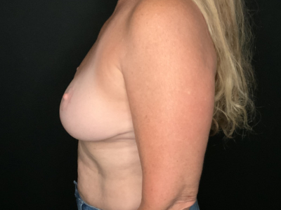 Patient #25475: Breast Implant Exchange with Lift and Capsulectomy After Image