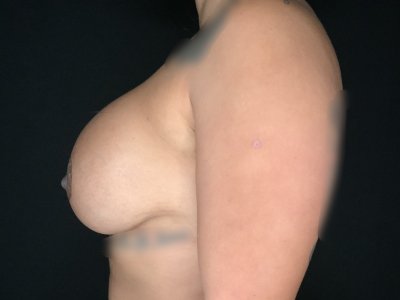 Patient #89674: Breast Implant Exchange After Image