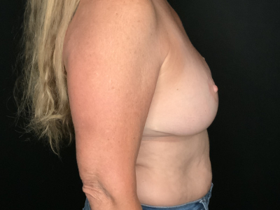 Patient #25475: Breast Implant Exchange with Lift and Capsulectomy After Image