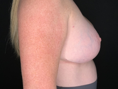 Patient #23656: Breast Implant Exchange with Lift and Capsulorrhaphy After Image