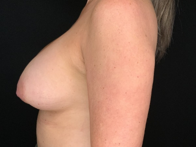 Patient #89578: Breast Implant Exchange, Capsulectomy with ADM, & Donut Mastopexy Before Image