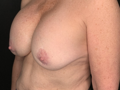 Patient #25475: Breast Implant Exchange with Lift and Capsulectomy Before Image