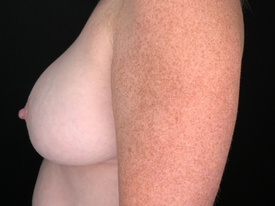 Patient #23656: Breast Implant Exchange with Lift and Capsulorrhaphy Before Image