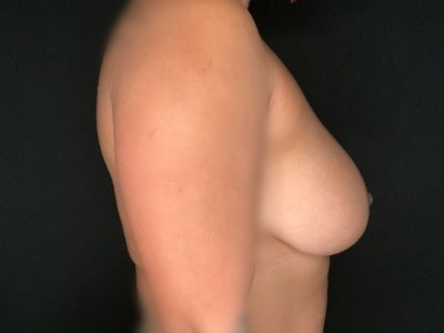 Patient #89674: Breast Implant Exchange Before Image