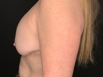 Patient #25475: Breast Implant Exchange with Lift and Capsulectomy Before Image
