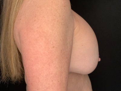 Patient #25475: Breast Implant Exchange with Lift and Capsulectomy Before Image