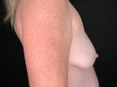 Patient #23656: Breast Implant Exchange with Lift and Capsulorrhaphy Before Image