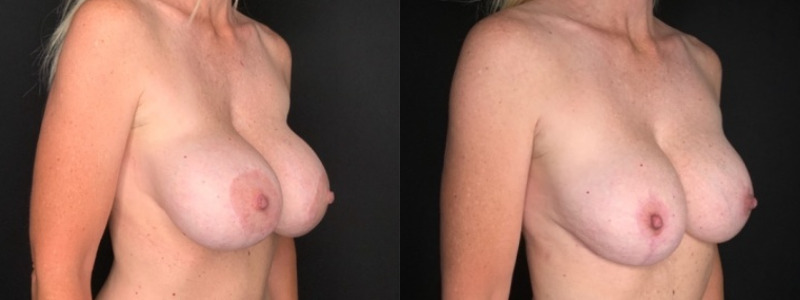 Patient #84020: Breast Implant Exchange with Capsulorrhaphy and Lift Combine Image