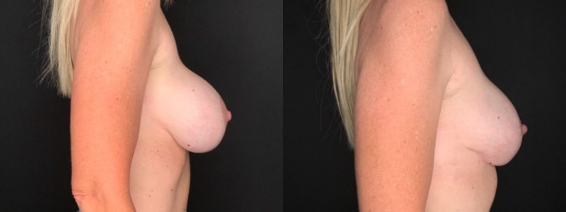 Patient #84020: Breast Implant Exchange with Capsulorrhaphy and Lift Combine Image