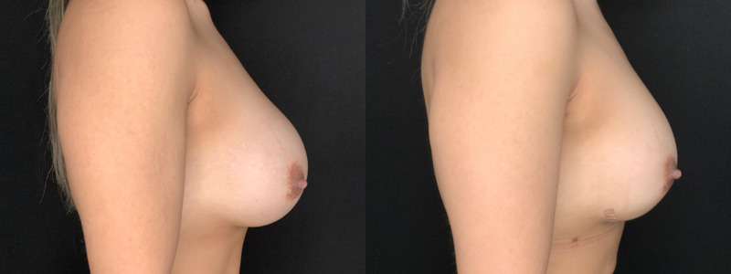 Patient #64521: Breast Implant Exchange with Capsulorraphy Combine Image