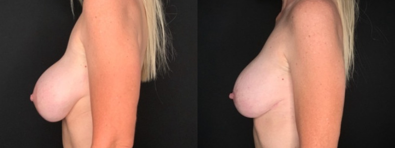 Patient #84020: Breast Implant Exchange with Capsulorrhaphy and Lift Combine Image