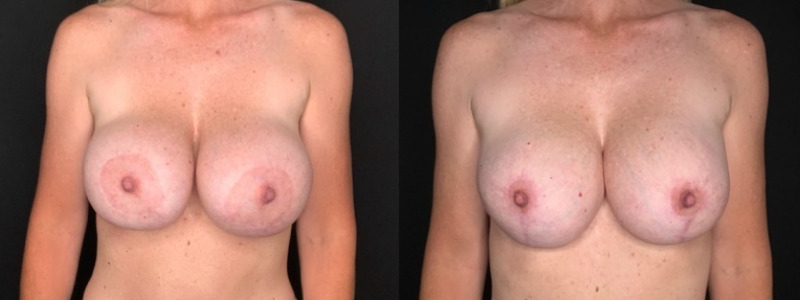 Patient #84020: Breast Implant Exchange with Capsulorrhaphy and Lift Combine Image