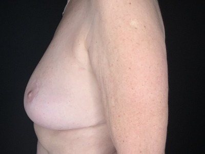 Patient #96875: Breast Implant Removal with Lift After Image
