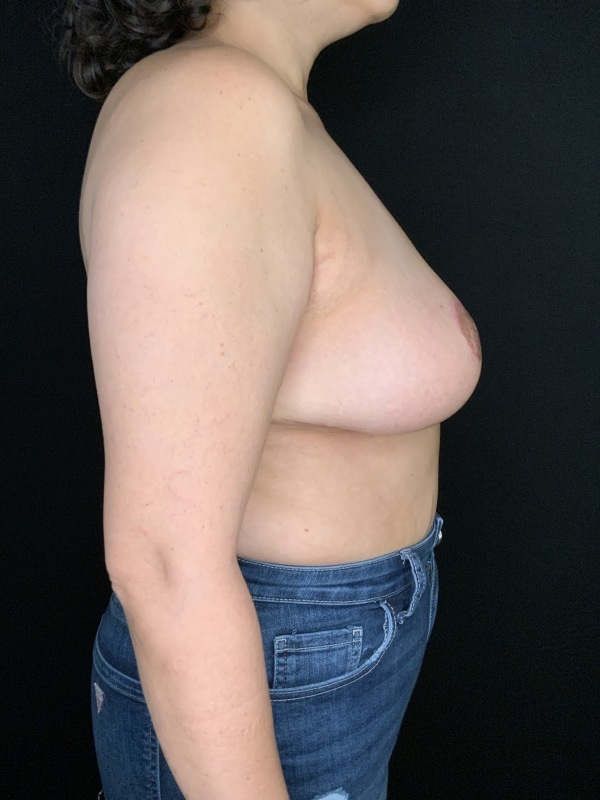 Patient #63256: Breast Implant Removal with Capsulectomy and Lift After Image