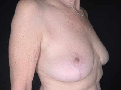 Patient #96875: Breast Implant Removal with Lift After Image