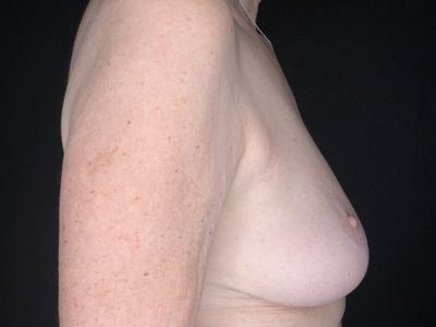 Patient #96875: Breast Implant Removal with Lift After Image