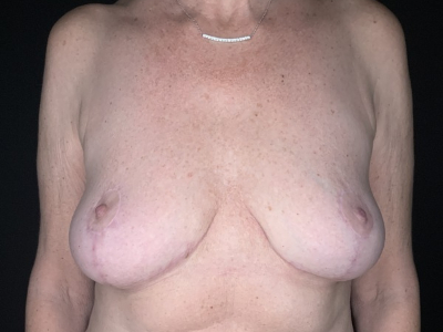 Patient #96875: Breast Implant Removal with Lift After Image