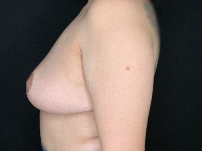 Patient #63256: Breast Implant Removal with Capsulectomy and Lift After Image
