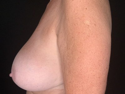 Patient #96875: Breast Implant Removal with Lift Before Image