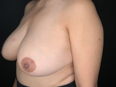 Patient #63256: Breast Implant Removal with Capsulectomy and Lift Before Image