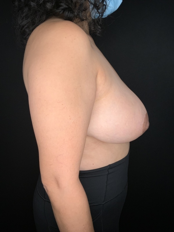 Patient #63256: Breast Implant Removal with Capsulectomy and Lift Before Image