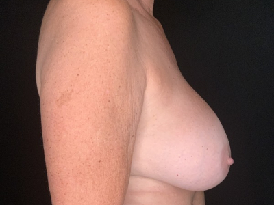 Patient #96875: Breast Implant Removal with Lift Before Image