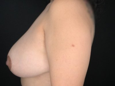 Patient #63256: Breast Implant Removal with Capsulectomy and Lift Before Image