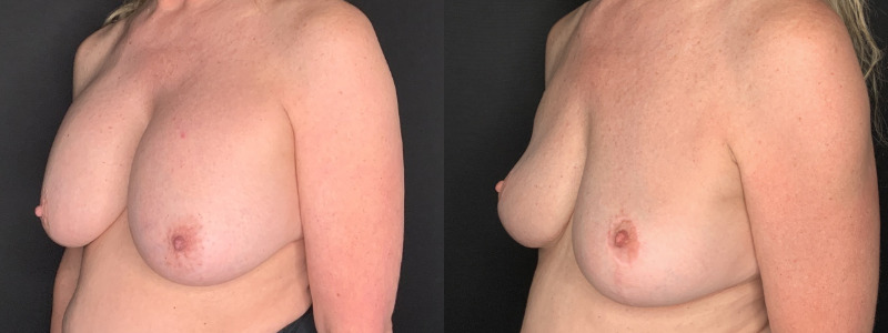 Patient #56427: Breast Implant Removal with Lift and Capsulectomy Combine Image