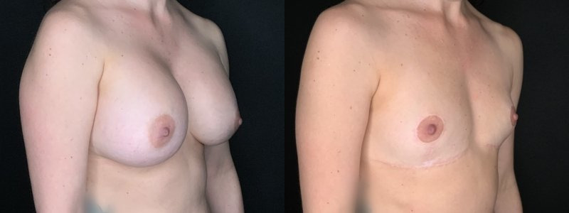 Patient #14569: Breast Implant Removal with Lift and Capsulectomy Combine Image