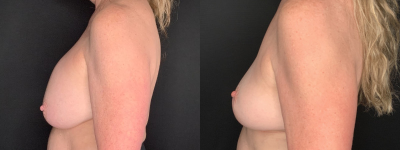 Patient #56427: Breast Implant Removal with Lift and Capsulectomy Combine Image