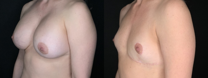 Patient #14569: Breast Implant Removal with Lift and Capsulectomy Combine Image