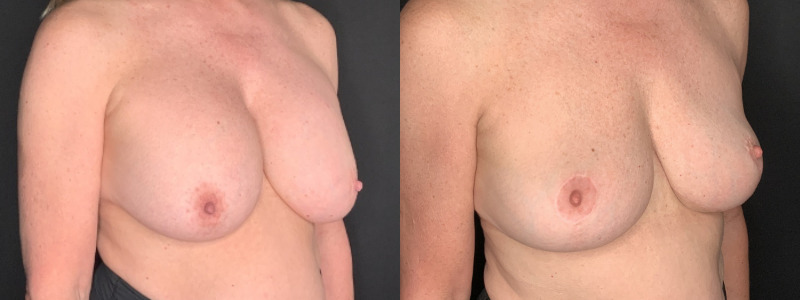 Patient #56427: Breast Implant Removal with Lift and Capsulectomy Combine Image