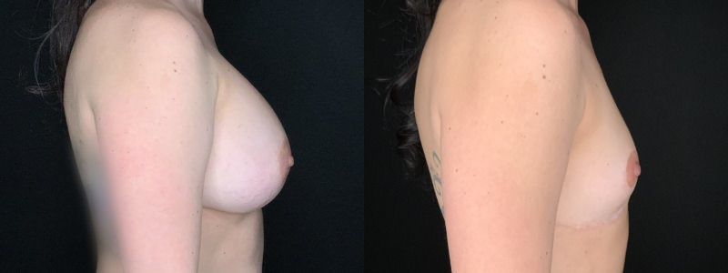 Patient #14569: Breast Implant Removal with Lift and Capsulectomy Combine Image