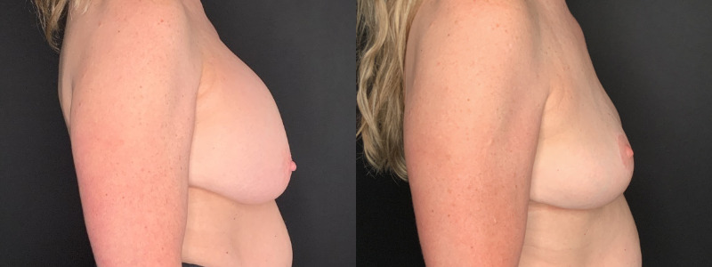 Patient #56427: Breast Implant Removal with Lift and Capsulectomy Combine Image