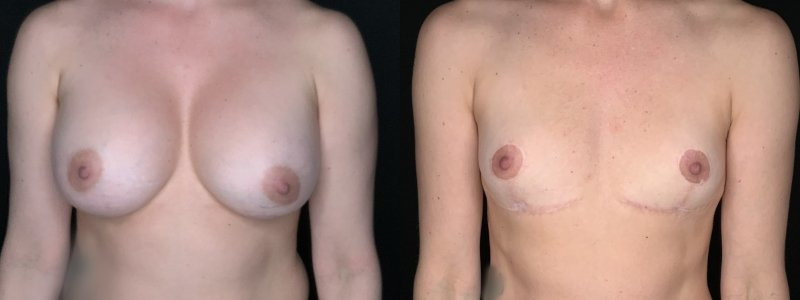 Patient #14569: Breast Implant Removal with Lift and Capsulectomy Combine Image