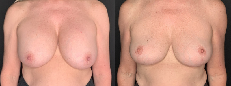 Patient #56427: Breast Implant Removal with Lift and Capsulectomy Combine Image