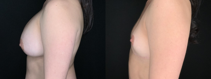 Patient #14569: Breast Implant Removal with Lift and Capsulectomy Combine Image