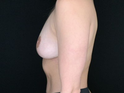 Patient #56985: Breast Lift After Image