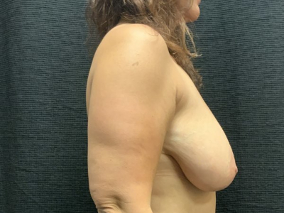 Patient #45745: Breast Lift Before Image
