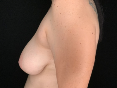 Patient #36598: Breast Lift Before Image