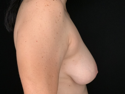 Patient #36598: Breast Lift Before Image